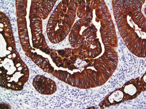 IHC of Cytokeratin 8 & 18 on an FFPE Colon Carcinoma Tissue